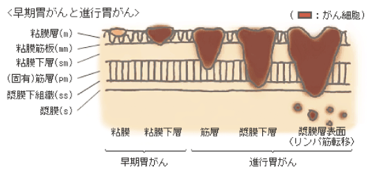 早期胃がんと進行胃がん