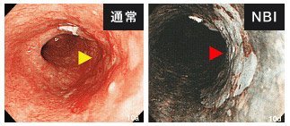 NBI(Narrow Band Imaging:狭帯域光観察)システムを導入